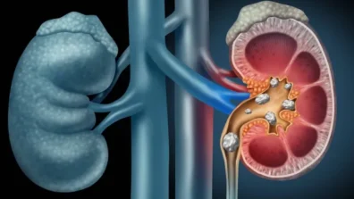 عادات يومية تحد من حصوات الكلى