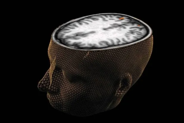 باحثون يكتشفون مؤشراً حيوياً قد يسهم في تحسين علاج الفصام