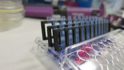 تقنية جديدة تسرّع علاج التهاب المسالك البولية