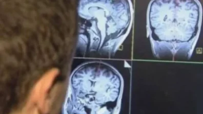 فيتامين يبطئ تقدم أحد أخطر أنواع سرطان الدماغ