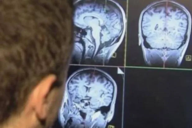 فيتامين يبطئ تقدم أحد أخطر أنواع سرطان الدماغ