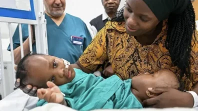 بدء عملية فصل التوأم الملتصق التنزاني «نانسي ونايس» في الرياض